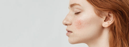 Couperose: cos’è e perché compare sul viso