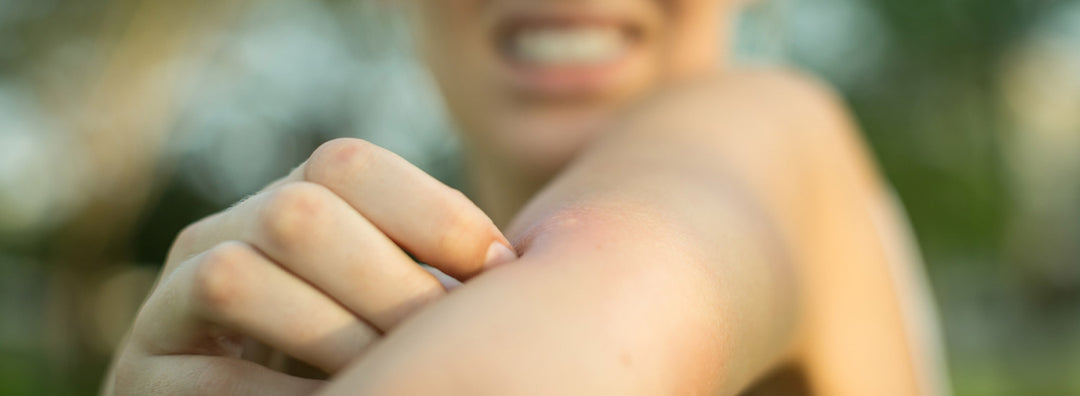 Punture d’insetto: cosa fare per prevenirle e alleviarle