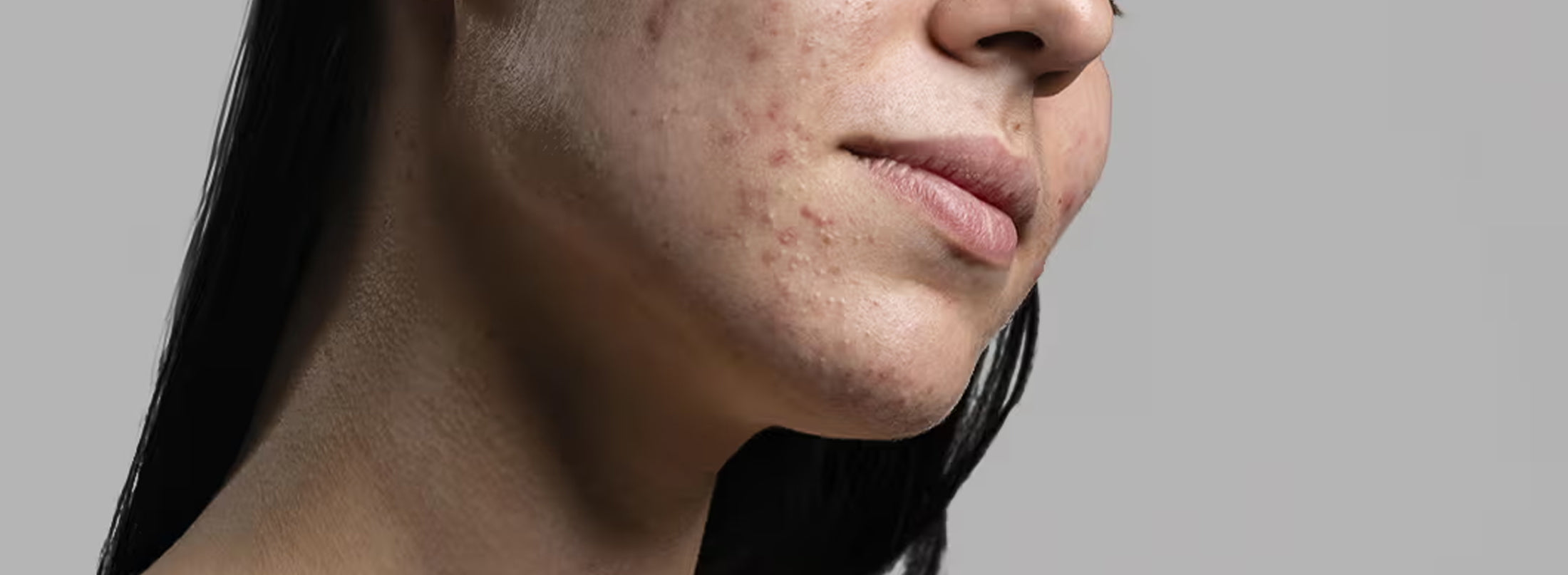 Il legame tra pelle impura e microbioma cutaneo