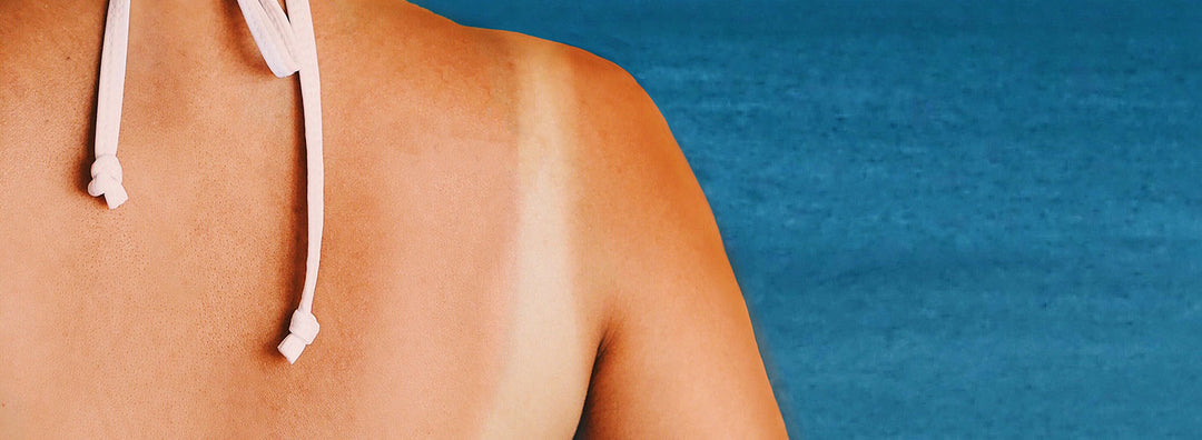 Hai preso un po’ troppo sole? Ecco che fare