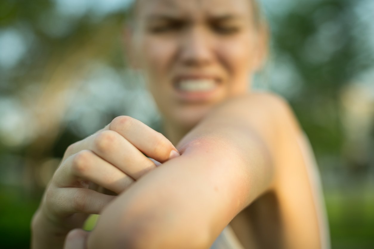 Punture d’insetto, come prevenirle e come alleviarle